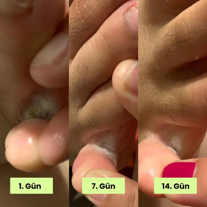 Loravey® Mantar Karşıtı Rahatlatıcı Sabun Bar